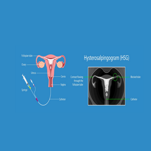 HSG Test with Anesthesia