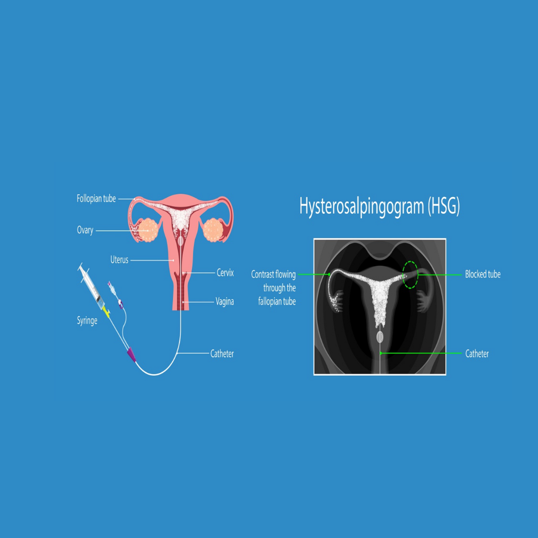 HSG Test with Anesthesia